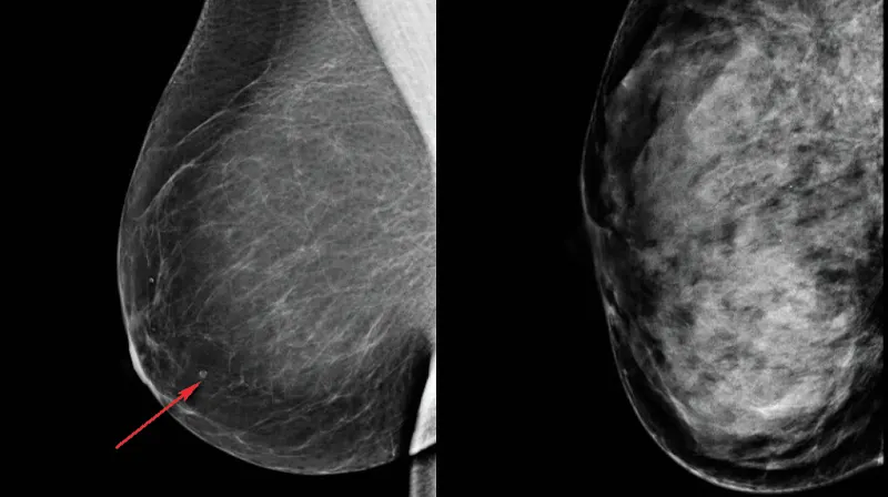 Dense Breasts: What Does This Mean? | Toms River X-Ray, CT & MRI Center